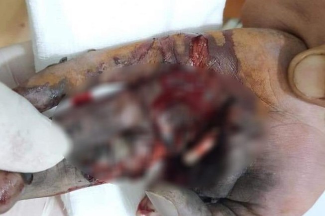 Điện thoại đang sạc phát nổ làm nát bàn tay thiếu niên: Ngày 18/1, em TXH (15 tuổi, ngụ tại Bình Phước) vẫn đang được điều trị tại bệnh viện vì điện thoại nổ nát bàn tay. Khuya ngày 17.1 em H. được chuyển đên bệnh viện đa khoa tỉnh Bình Phước cấp cứu trong tình trạng bàn tay trái bị nát do điện thoại phát nổ. 