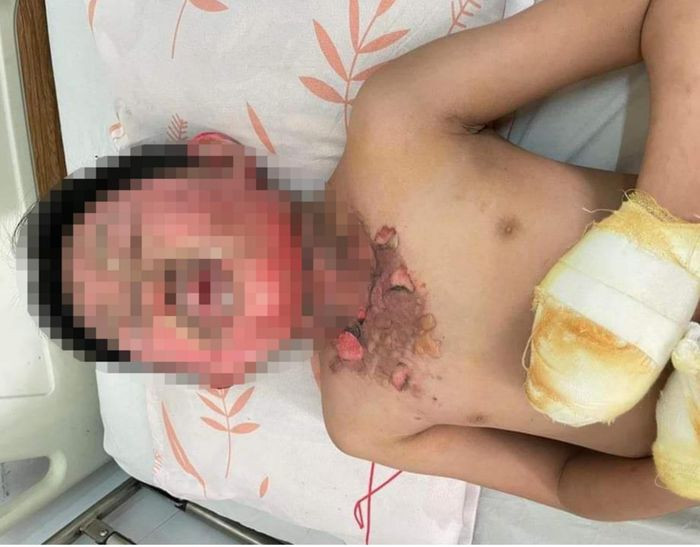  Khởi tố người cha đổ xăng tự thiêu cùng con trai do mâu thuẫn: Đến nhà bố mẹ vợ tìm vợ để giải quyết mâu thuẫn nhưng không thấy ai ra mở cửa, Nguyễn Việt Huy (SN 1991, trú xã Ia Der, huyện Ia Grai, Gia Lai) đổ xăng lên người mình và con trai rồi châm lửa. Hậu quả khiến cháu N.B.L. (SN 2013) bị bỏng nặng. Ngày 5/2, Công an tỉnh Gia Lai cho biết đã khởi tố, bắt tạm giam Huy.