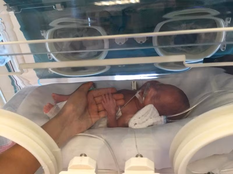 Bé Hán Bảo A. (sinh non 25 tuần, nặng 570gram) lúc mới sinh chỉ nhỏ bằng cổ tay người lớn, với nhiều nguy cơ kèm theo.