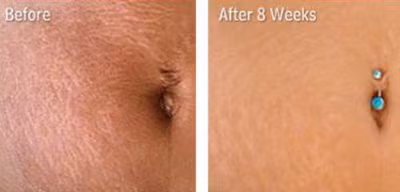 Làm liền vết rạn và săn chắc da - Hình 2 Lam lien vet ran va san chac da-Hinh-2