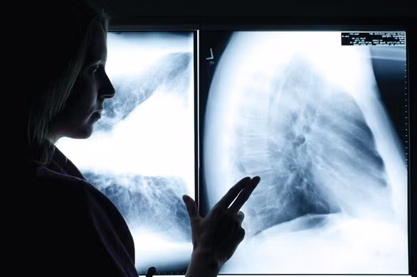 Phụ nữ thường có phản ứng tốt với các phương pháp hóa trị chữa ung thư phổi hơn là đàn ông.