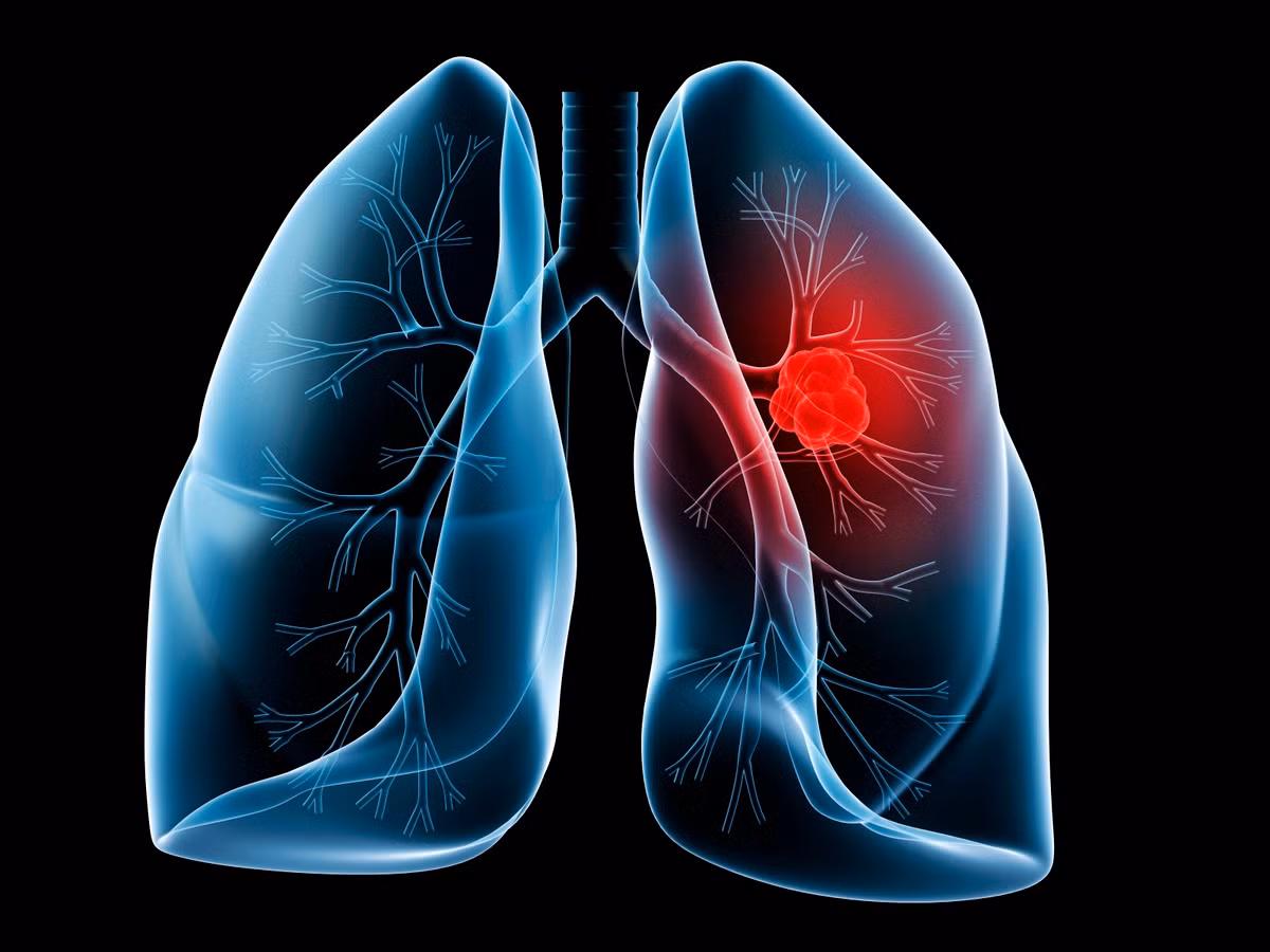 Theo số liệu về bệnh ung thư phổi ở Mỹ, tuy số lượng nam giới bị bệnh này rất nhiều, nhưng ung thư phổi lại là bệnh ung thư khiến phụ nữ chết nhiều nhất, hơn cả ung thư vú. Hiện tại, số lượng phụ nữ bị ung thư phổi đang gần bằng đàn ông.