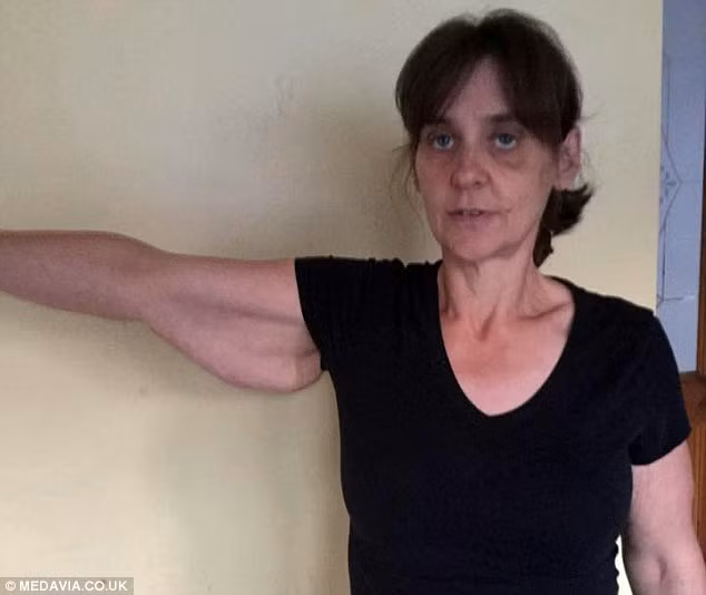 Nguyên nhân của việc này là do khi tăng cân, protein elastin giúp da co lại và collagen giúp da săn chắc bị kéo giãn quá mức. Chúng "vỡ" ra khiến da không còn những protein này nữa.