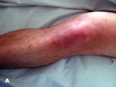 Sau đó, trên cơ thể sẽ xuất hiện những vết phát ban. Mắt, miệng, cổ họng, và âm đạo sưng đỏ, đau đầu, rối loạn, mất phương hướng, hoặc co giật