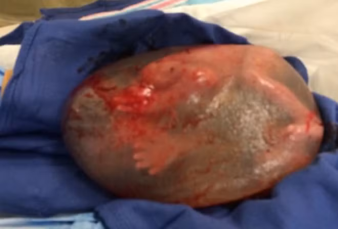 Hiện tượng này thường xảy ra ở những bà mẹ sinh non. Ngay sau khi được đưa ra khỏi bụng mẹ, các bác sĩ đã rạch túi ối để em bé có thể thoát ra ngoài.