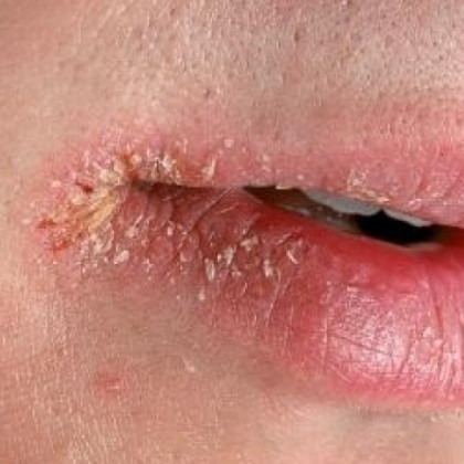 Hiện tượng chốc lở khóe miệng khiến bạn khó ăn, cười, nói cũng có nguyên nhân là vì bạn thiếu sắt, khi 35% bệnh nhân bị bệnh này là do thiếu máu.