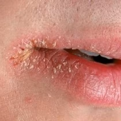 Hiện tượng chốc lở khóe miệng khiến bạn khó ăn, cười, nói cũng có nguyên nhân là vì bạn thiếu sắt, khi 35% bệnh nhân bị bệnh này là do thiếu máu.