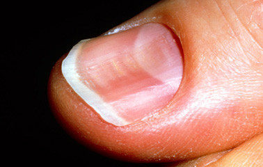 Hiện tượng móng tay thìa (như trong hình) cũng là dấu hiệu cảnh báo bạn đang thiếu sắt.