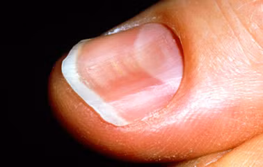 Hiện tượng móng tay thìa (như trong hình) cũng là dấu hiệu cảnh báo bạn đang thiếu sắt.