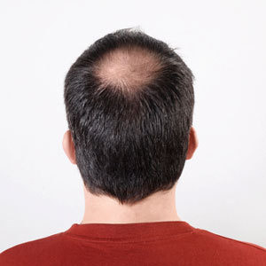 Những người đàn ông bỗng nhiên bị rụng tóc (bị hói) hãy cẩn trọng, bởi bạn đang có nguy cơ bị bệnh tim: đau tim nhẹ, đau ngực, và nghẽn động mạch vành.