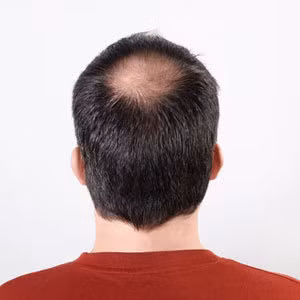 Những người đàn ông bỗng nhiên bị rụng tóc (bị hói) hãy cẩn trọng, bởi bạn đang có nguy cơ bị bệnh tim: đau tim nhẹ, đau ngực, và nghẽn động mạch vành.