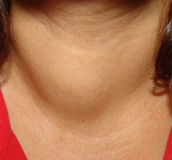 Bình thường, hệ thống miễn dịch có chức năng bảo vệ cơ thể chống lại các vi khuẩn và virut, khi mắc bệnh Hashimoto, hệ miễn dịch lại là nơi sinh ra những kháng thể tấn công vào các cơ quan, trong đó có tuyến giáp.