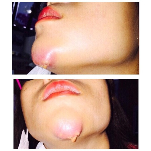 Kinh hoang bien chung quy co sinh tiem filler don cam V-line rom