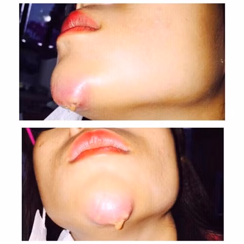 Kinh hoang bien chung quy co sinh tiem filler don cam V-line rom