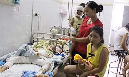 Phú Thọ Đổ cồn nướng mực gần quạt 3 trẻ bỏng nặng Phu Tho Do con nuong muc gan quat 3 tre bong nang