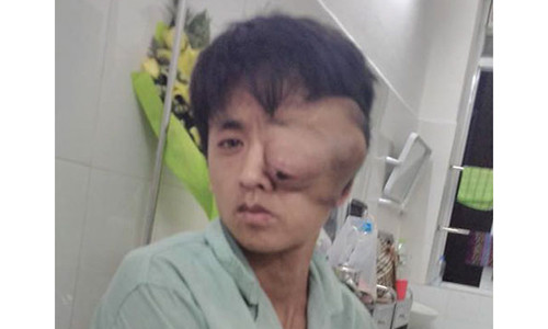 Nguoi dan ong mat loi ra khoi trong vi khoi u khong lo