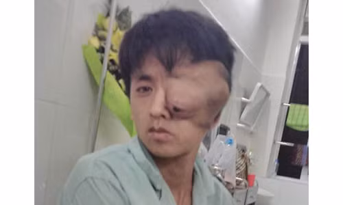 Nguoi dan ong mat loi ra khoi trong vi khoi u khong lo