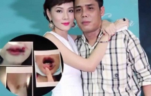 Duong Yen Ngoc di sua mui sau khi bi chong cu danh dap-Hinh-2