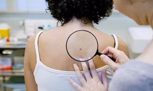 Thuong xuyen di o to xe buyt de mac benh ung thu da