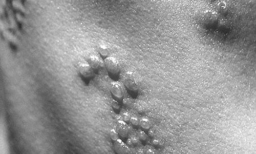 Meo mieng, nhiem trung vi dap dau xanh chua zona than kinh