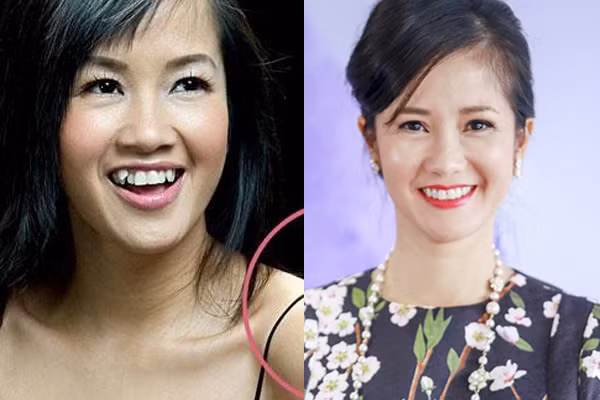 "Cô Bống" Hồng Nhung nổi tiếng một thời với chiếc răng khểnh duyên dáng, tuy nhiên vì sợ bị ảnh hưởng đến sức khỏe nên cô đã quyết định tìm đến các nha sĩ để có được hàm răng đều tăm tắp.