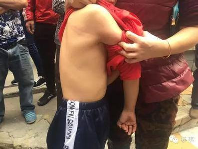 Lưng một em học sinh vẫn còn in lốt bị thầy đánh.