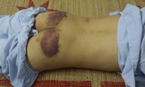 Cháu T. nhập viện trong tình trạng trên người có nhiều vết thương nghi vấn do bị mẹ kế bạo hành.