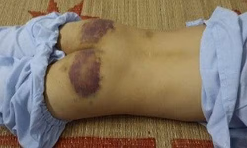 Cháu T. nhập viện trong tình trạng trên người có nhiều vết thương nghi vấn do bị mẹ kế bạo hành.