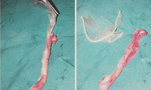 Các bác sỹ đã phát hiện ra một miếng bao cao su bị tắc trong ruột thừa. (Nguồn: DM)