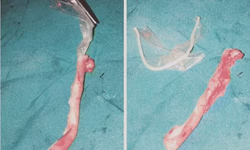 Các bác sỹ đã phát hiện ra một miếng bao cao su bị tắc trong ruột thừa. (Nguồn: DM)