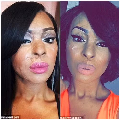 Noi dau tat axit ban than chi vi do ky