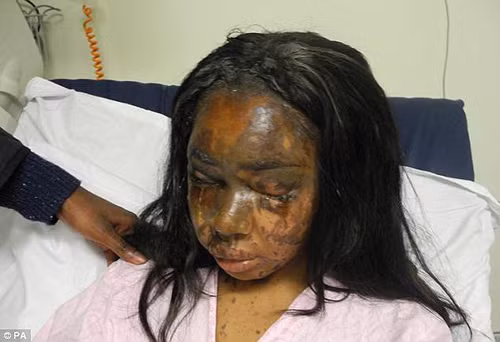 Noi dau tat axit ban than chi vi do ky-Hinh-2