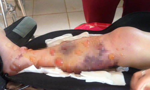 Bệnh nhân Vi bị hoại tử chân (ảnh gia đình nạn nhân cung cấp).