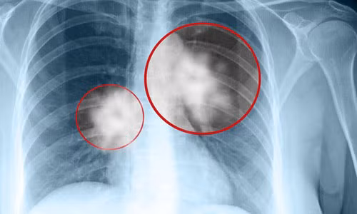 Khong hut thuoc la sao nghe si Han Van Tinh van bi ung thu phoi?