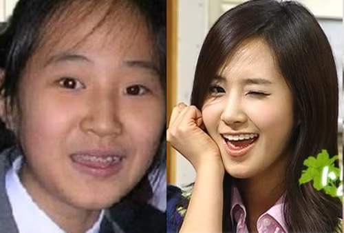 Người đẹp Yuri của nhóm SNSD cũng phải niềng răng trong một thời gian dài, thậm chí trong cả giai đoạn là thực tập sinh của nhà SM. Chính vì thế cô đã khá ngại ngùng mỗi khi phải chụp ảnh cùng các bạn khác.