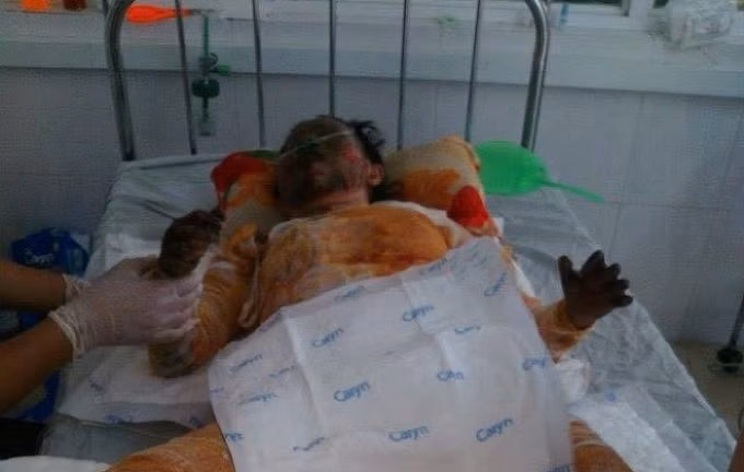 Xot thuong co gai xinh dep bi bong cap do 5 do xang bat ngo chay-Hinh-2