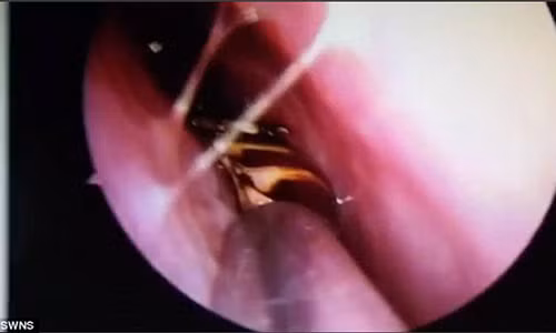 Soc nang khi phat hien gian song trong so nguoi