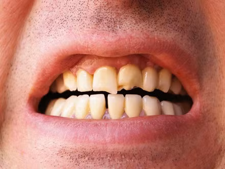 Thưa răng: Sử dụng tăm thường xuyên sẽ tạo ra một khoảng trống ở giữa các răng. Điều này sẽ tạo cơ hội cho các loại thức ăn mắc kẹt ở răng dễ dàng hơn, từ đó dẫn đến sự hình thành các hốc răng sâu.