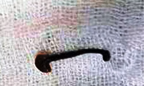 Kinh hai con vat chui vao ngach mui cua be trai 13 tuoi