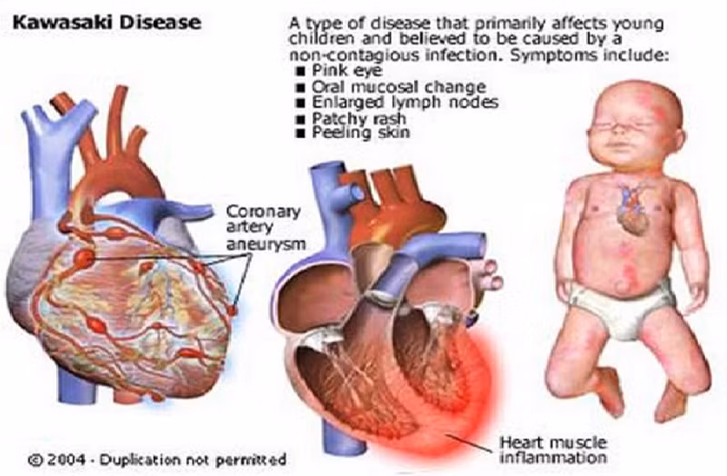 Dau hieu nhan biet va cach cham soc tre bi benh Kawasaki-Hinh-3