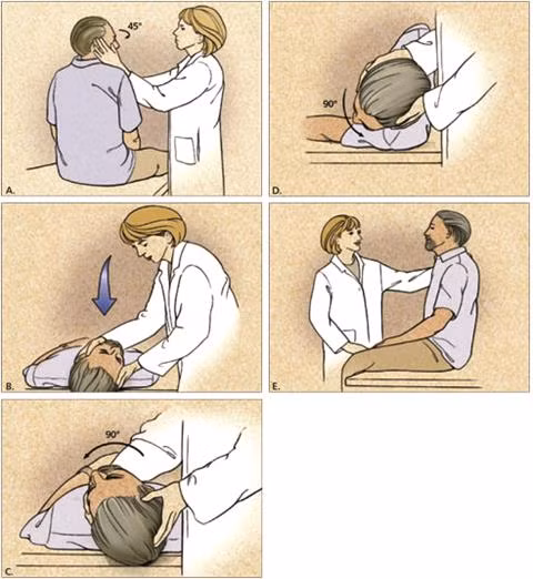 Tập hợp vận động đầu Epey manoeuvre cần được sự hỗ trợ của chuyên gia vật lý trị liệu.