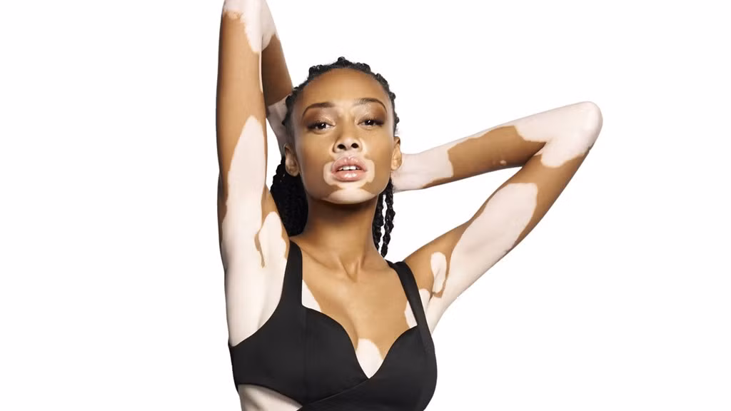 Chantelle Brown-Young (22 tuổi, Canada) là thí sinh đặc biệt của America’s Next Top Model mùa 21. Với làn da loang lổ những đốm trắng do căn bệnh bạch biến, Chantelle sở hữu vẻ đẹp lạ và mang đến nguồn cảm hứng cho các nhiếp ảnh gia - những người luôn muốn tìm kiếm điều mới mẻ.