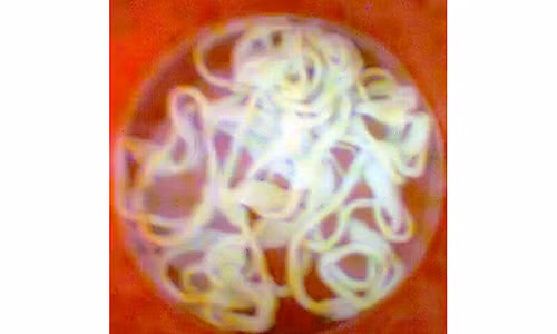 Kinh hai san 12m song trong bung nguoi phu nu 9 nam