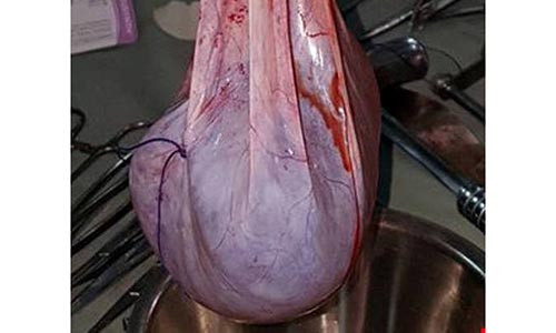 Cat bo khoi u nang nang 6kg cho cu ba 102 tuoi