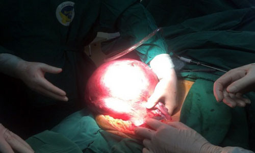 Mo lay khoi u tu cung 12kg cho nguoi dan ba 53 tuoi