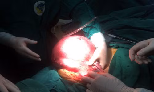 Mổ lấy khối u tử cung 12kg cho người đàn bà 53 tuổi Mo lay khoi u tu cung 12kg cho nguoi dan ba 53 tuoi