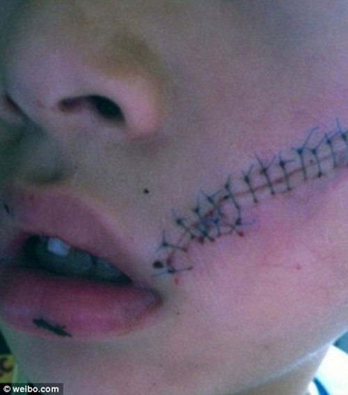 Mới đây, một bà mẹ Trung Quốc đã chia sẻ hình ảnh con trai mình với khuôn mặt chằng chịt các vết khâu bên má trái kèm theo chú thích cảnh báo tất cả mọi người về nguy cơ lon nước ngọt trong tủ lạnh phát nổ. Theo đó, một cậu bé Trung Quốc có thói quen uống nước ngọt như mọi ngày. Thế nhưng, sau khi vừa lấy lon nước ngọt ra khỏi tủ đông được một lát thì lon nước đó phát nổ gây thương tích khủng khiếp cho cậu bé. Những mảnh thiếc của lon nước ngọt cắt ngang qua mặt khiến cậu bé phải khâu 38 mũi, trong đó có 7 mũi ở trong miệng.