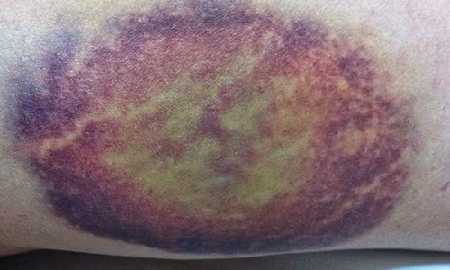 Canh giac voi not bam tim tren co the