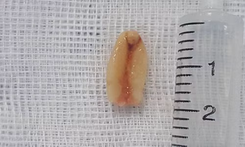 Tuong con viem phe quan, khong ngo hat lac nam trong duong tho