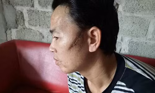 Chem hang xom vo xuong ham vi giang micro hat trong dam cuoi